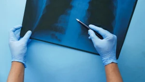 Перелом ребра