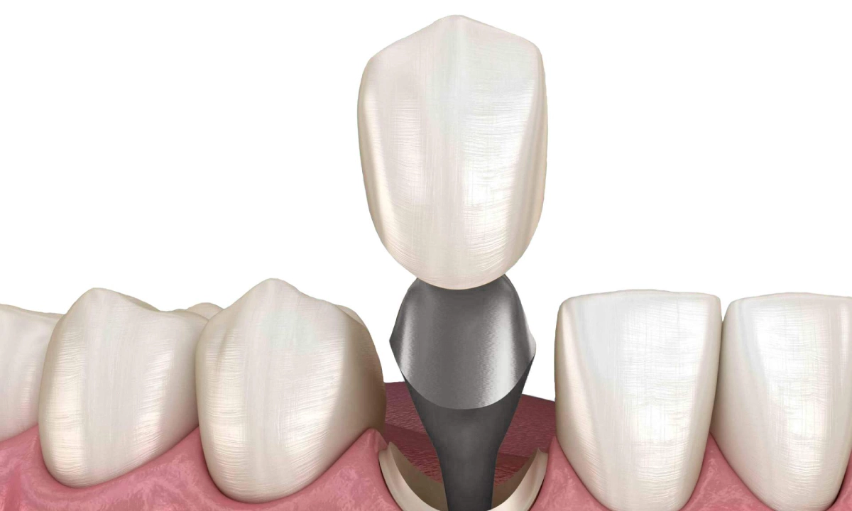 Одномоментна імплантація 