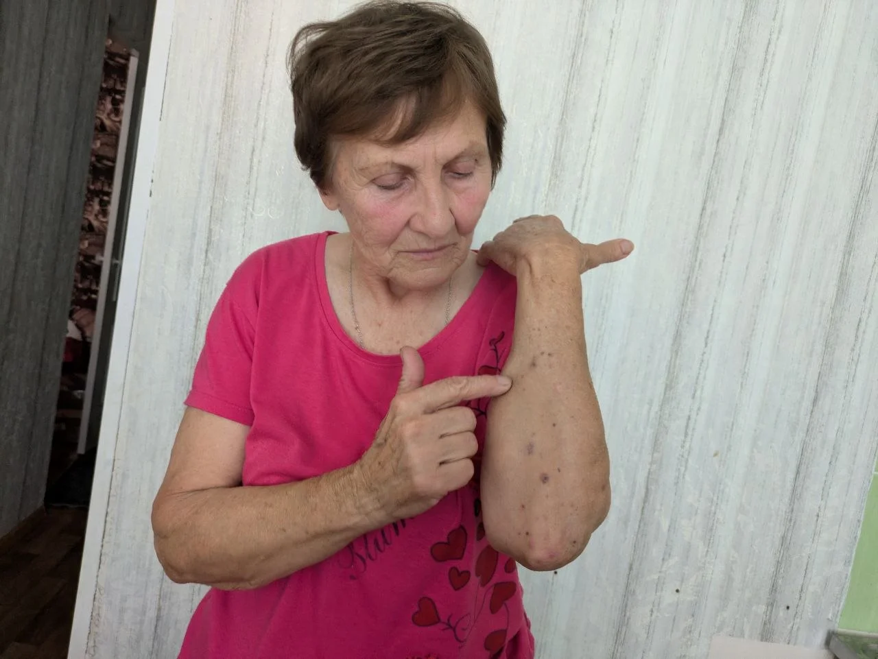 Людмила Березка показує сліди від поранення уламками на руці
