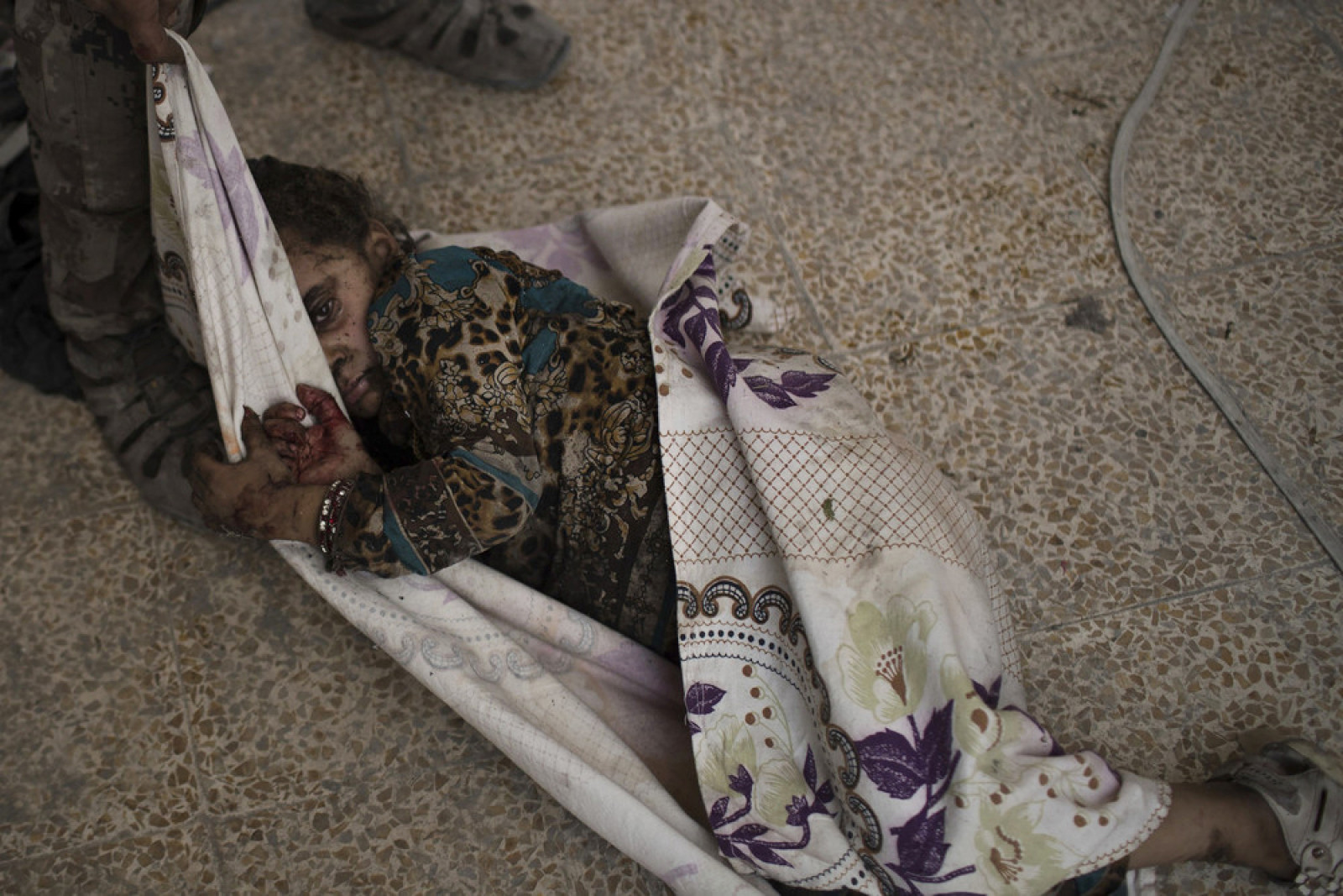 Поранена дівчинка чекає медичної допомоги в місті Мосул, Ірак, 3 липня 2017. (Photo by Felipe Dana / AP Photo)